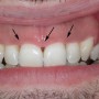 Σχηματισμός μαύρων τριγώνων ανάμεσα στα δόντια μετά απο θεραπεία Ελκονεκρωτικής ουλίτιδας
